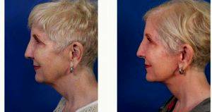 Dr John M. Hilinski, MD, San Diego Facial Plastic Surgeon - Lower Facelift And Upper Neck Lift Surgery