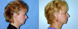 Dr Lewis Ladocsi, MD, FACS, Richmond Plastic Surgeon - 55 Year Old Woman Who Was Unhappy With Her Appearance