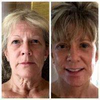 Dr Mark Karolak Facial Lift Before And After Results