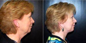 Dr Pedro M. Soler, Jr., MD, Tampa Plastic Surgeon - 63 Year Old Woman Treated With Facelift