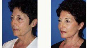 Dr Sam Gershenbaum, DO, Miami Plastic Surgeon - 64 Year Old Woman Treated With Facelift