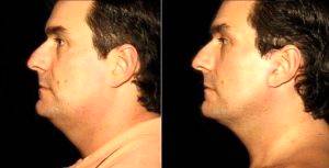 Dr Thomas M. DeWire Sr., MD , Richmond Plastic Surgeon - Male SMAS Facelift In A 40-year-old