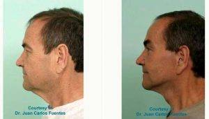 Dr. Juan Carlos Fuentes, MD, Mexico Plastic Surgeon - Facelift And Eyelift Surgery