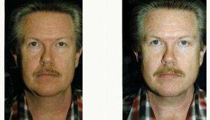 Dr. Robert H. Hunsaker, MD, Miami Plastic Surgeon - 59 Year Old Man Treated With Facelift Before & After