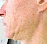 Dr. Ronald Caniglia Surgical Face Lift Results Picture