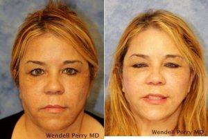 Dr. Wendell Perry, MD, Miami Plastic Surgeon - 48 Year Old Woman Treated With Facelift