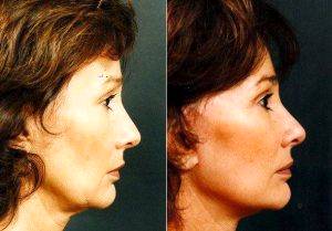 Facelift Before & After By Doctor Richard Galitz, MD, FACS, Miami Facial Plastic Surgeon