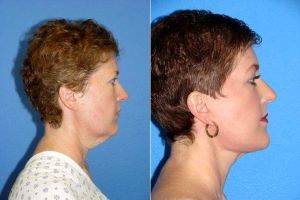 Facelift Before & After With Doctor Joshua Halpern, MD, PA, Tampa Plastic Surgeon