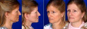 Facelift Before & After With Dr. Matthew Bridges, MD, Richmond Facial Plastic Surgeon