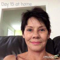 Facelift Day 15