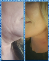 Facelift For Jowls Before And After
