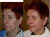 Facelift In Operating Room Before And After