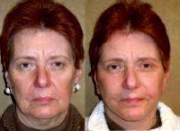 Facelift In USA Before And After