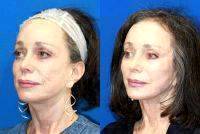 Facelift In United States Before And After