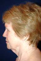 Facelift Procedure Involves Incisions That Skirt The Contour Of The Ears
