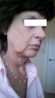 Facelift Under Local Anesthesia