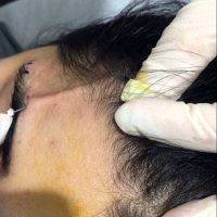 Feather Lift Is Less Invasive Than A Full Facelift