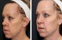 Filler For Face Before And After Photo