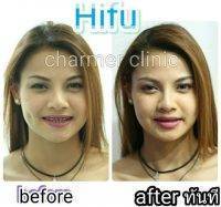 HIFU Before And After (6)