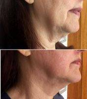 HIFU Facelift Before And After (1)