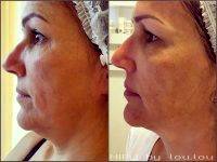 HIFU Facelift Before And After (6)