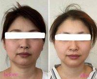 HIFU Facelift Treatment Before And After (2)