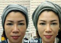 HIFU Facelift Treatment Before And After (3)