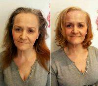 HIFU Facelift Treatment Before And After (6)