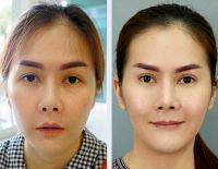 HIFU Facelift Treatment Before And After (7)