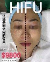 HIFU Facial Before And After (1)