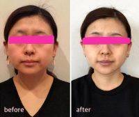 HIFU Facial Before And After (10)