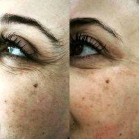 HIFU Facial Before And After (2)