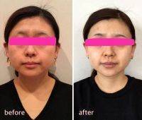 HIFU Facial Before And After (3)