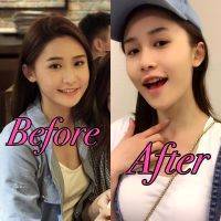 HIFU Facial Before And After (4)