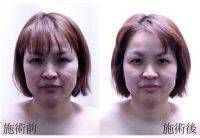 HIFU Facial Treatment Before And After (10)
