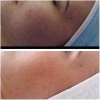 HIFU Facial Treatment Before And After (3)