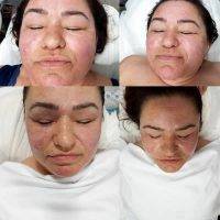 HIFU Facial Treatment Before And After (6)