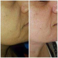 HIFU Facial Treatment Before And After (7)