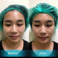 HIFU For Face Before And After (10)