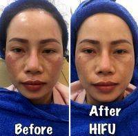 HIFU For Face Before And After (5)