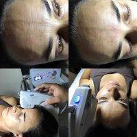 HIFU For Face Before And After (8)