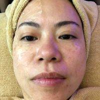 HIFU Non-Surgical Face Lift Before And After (1)