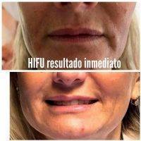 HIFU Non-Surgical Face Lift Before And After (4)