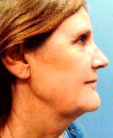 Improve The Loose Skin Of The Neck