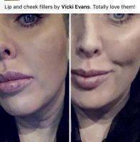 Lip And Cheek Fillers