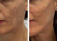Liquid Cheek Lift Before And After