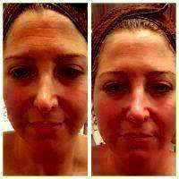 Liquid Facelift California Before And After