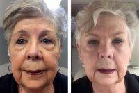 Liquid Facelift Delaware Before And After