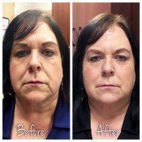 Liquid Facelift Florida Before And After