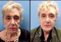 Liquid Facelift Virginia Before And After